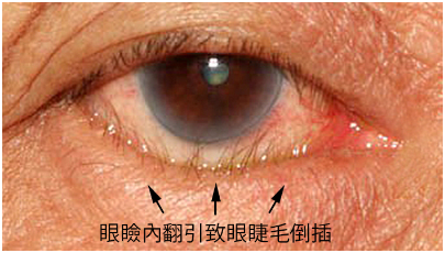 希玛医生解析:眼睑内翻是怎么回事_深圳