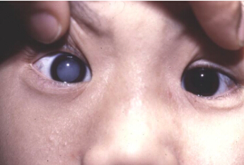 儿童白内障