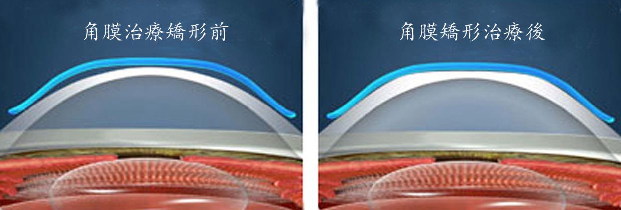角膜塑形