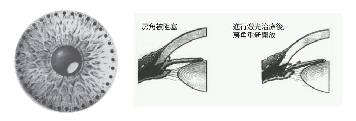 急性青光眼新方法——激光虹膜边缘成形手术