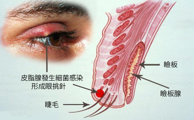 眼跳针
