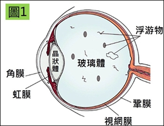 飞蚊症