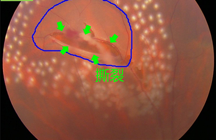 视网膜撕裂