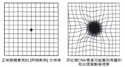 深近视引起的黄斑病变 