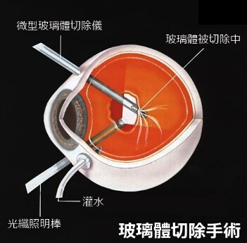 深近视引起的黄斑病变