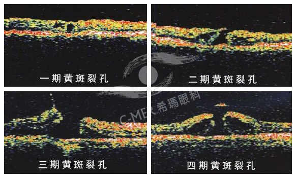 黄斑裂孔一定要手术吗