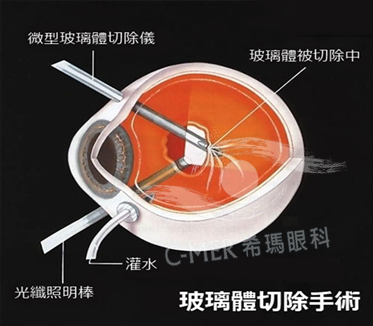 黄斑病变得警惕这些症状