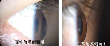 圆锥角膜治疗方案——角膜胶原交联术 