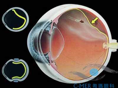 视网膜脱落