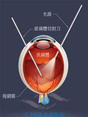 “蚊子”剧增原来是视网膜脱落的前兆