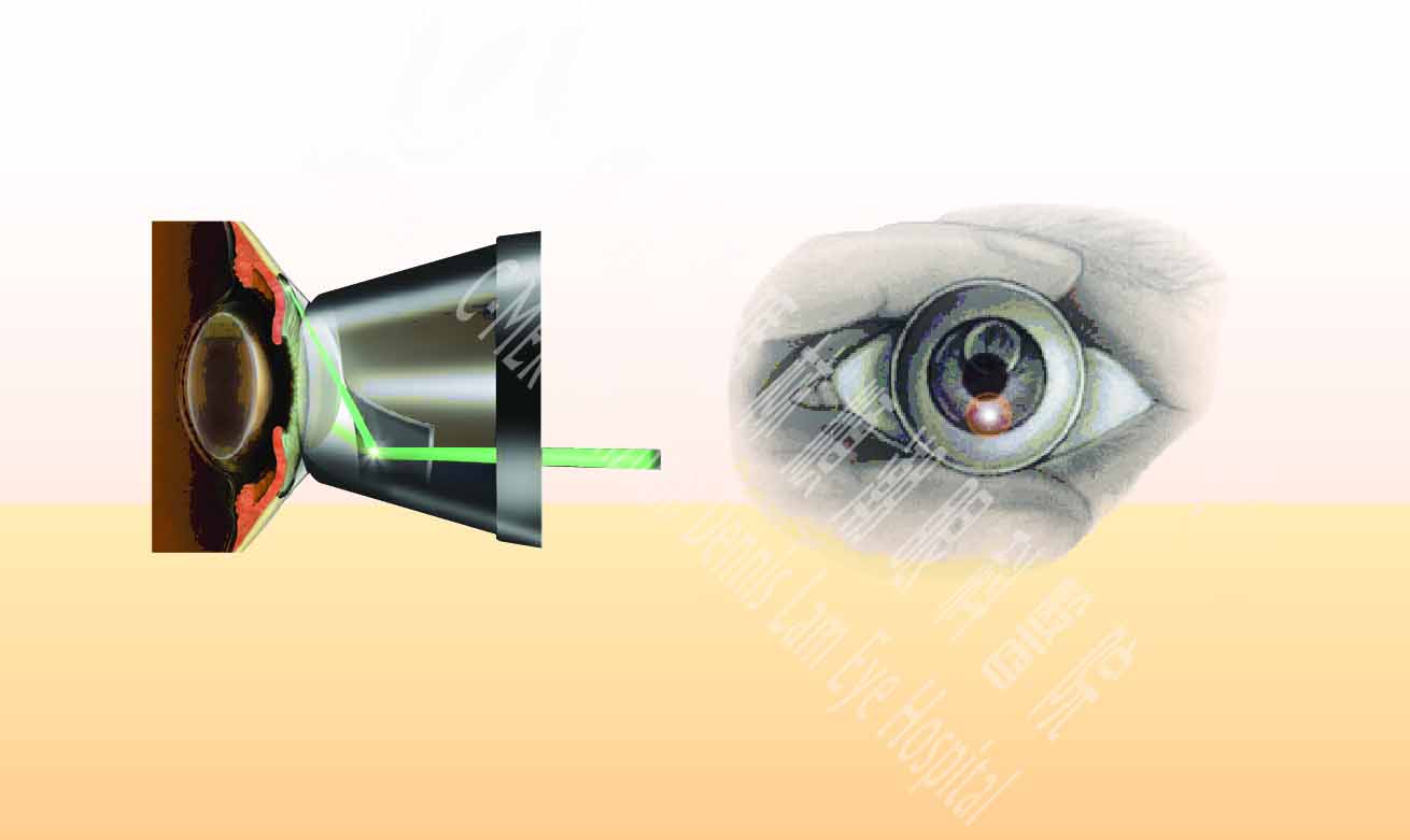 急性青光眼新方法——激光虹膜边缘成形手术