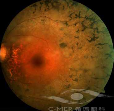 视网膜色素变性 出现的典型