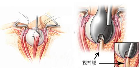 眼球摘除手术需要切断与眼球和眼眶的联系，包括肌肉和神经