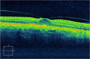 Oct检查黄斑水肿