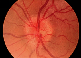 后葡萄膜炎视神经发炎令视神经充血和水肿明显，可严重影响视力