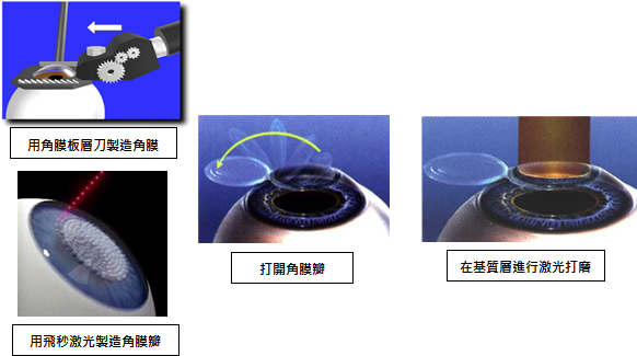 激光矫正步骤