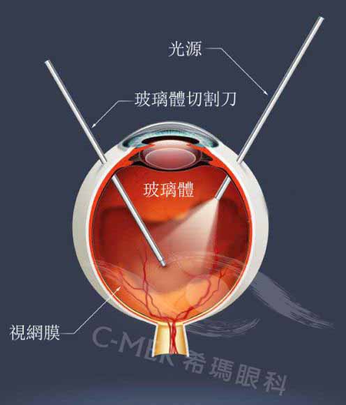 在深圳视网膜脱落怎么治