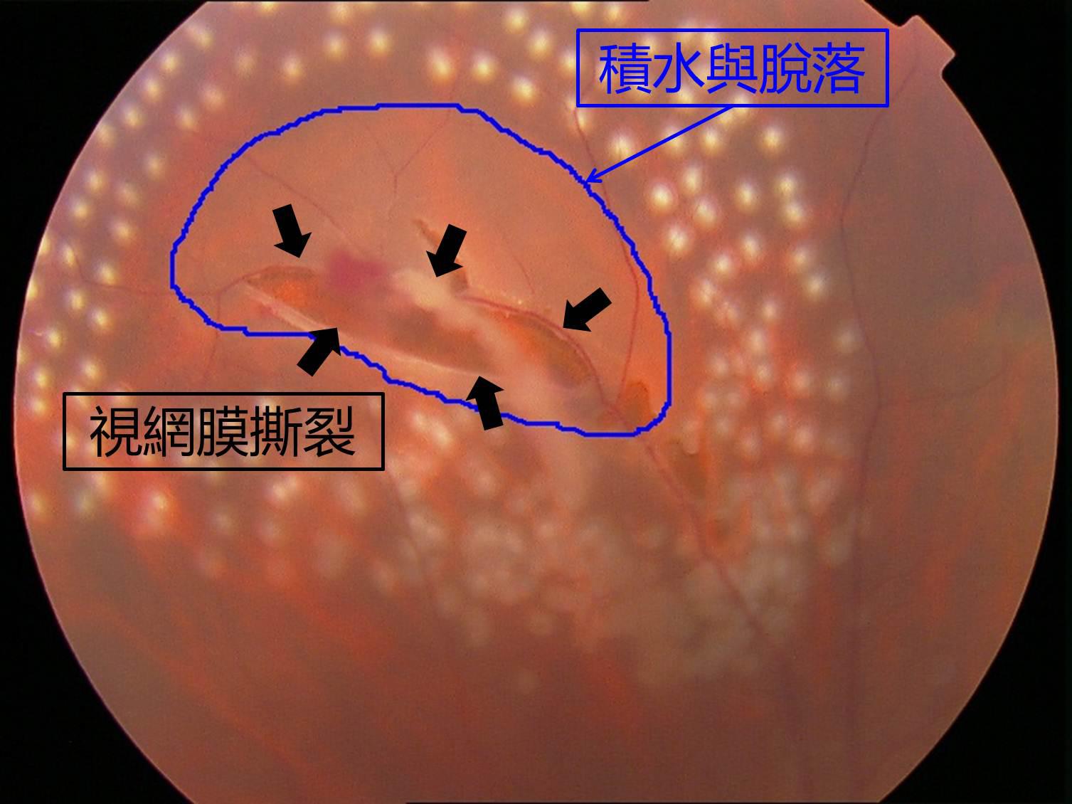 激光治疗视网膜裂孔