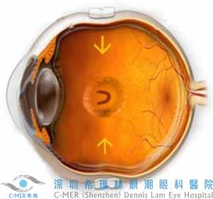视网膜脱落了，手术后视力还能如初吗?