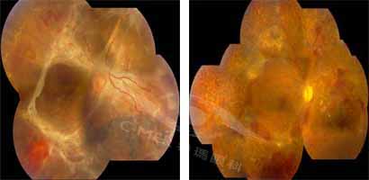 增殖性玻璃体视网膜病变