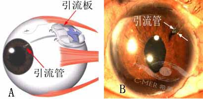 (A) 房水通过引流管进入引流板，平均分布在引流板周围，并在结膜下分散吸收。一般情况下，引流管很少堵塞，多数是引流板表面出现纤维膜而减少房水吸收。(B) 白色箭咀指示伸入前房的引流管