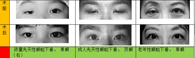 眼睑下垂、