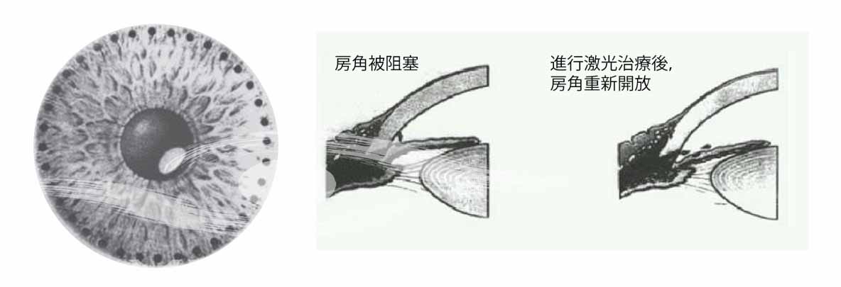 (激光虹膜边缘成形手术在虹膜边缘360度打激光,房角重新,让房水重新