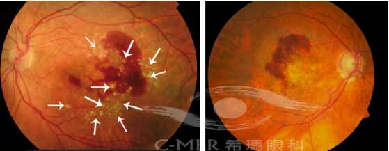 典型的黄斑退化的病人除出血外还能见到很多黄色渗漏(左)，而诸多中国特殊黄斑退化——息肉状脉络膜血管病变患者虽然眼底也有出血但是没有明显的黄色渗漏(右))
