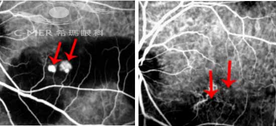 息肉状的脉络膜血管病变经PDT治疗后病变有效消退