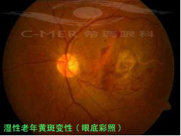 黄斑病变这种病分为哪些类型?