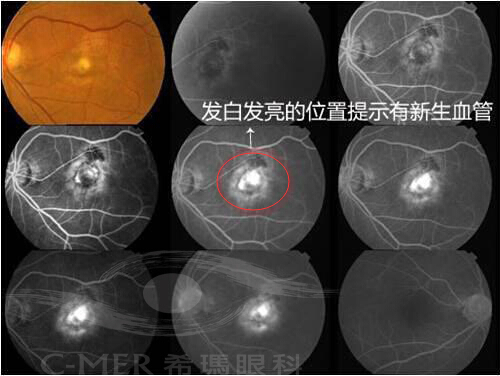 彩色照片是造影前的眼底像，黑白照片是注射造影剂后的眼底像。医生通过造影检查的照片，观察血管是否有出血，渗出等异常症状。）