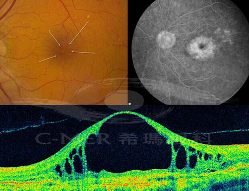OCT检查黄斑出现病变及水肿