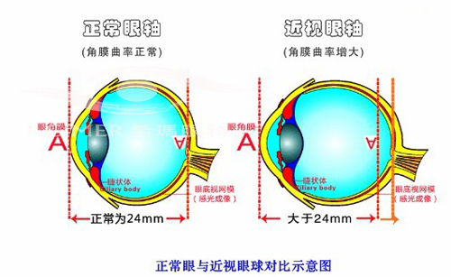 高度近视能戴隐形眼镜吗?
