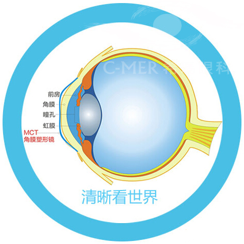 深圳希玛林顺朝眼科医院角膜塑形镜