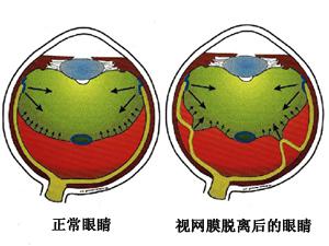 视网膜脱落