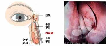 泪道阻塞的部位及治疗方法