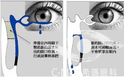 鼻泪管堵塞手术的治疗