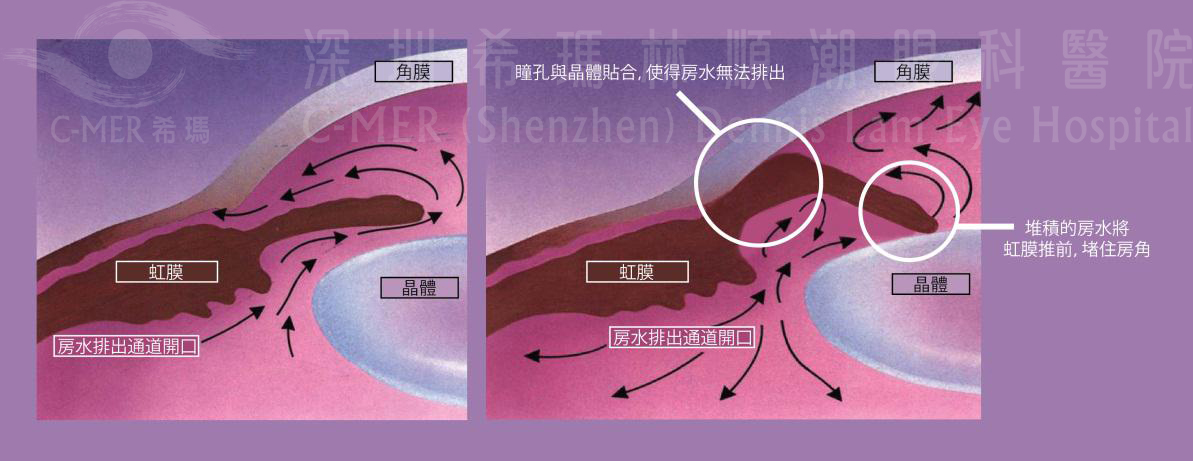 深圳眼科医院治疗青光眼