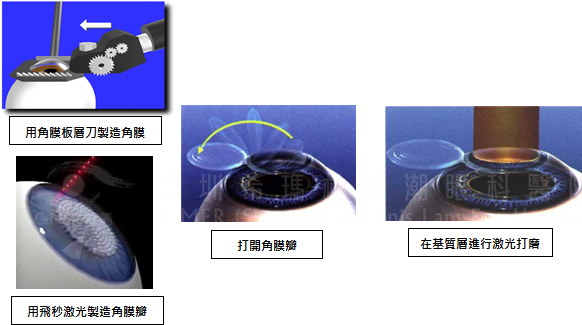 飞秒激光是近视患者的优选