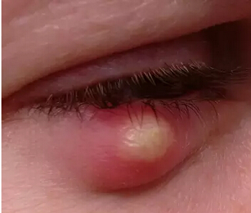 “针眼”的家庭护理要点