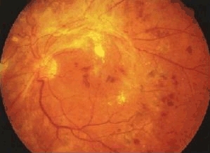 糖尿病性视网膜病变的类型