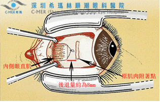 黑眼珠偏离，警惕眼斜视