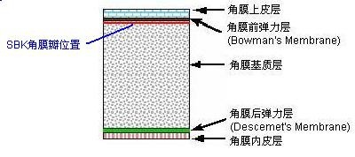 术后出现圆锥角膜，难道是近视手术“惹祸”？