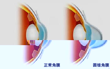 术后出现圆锥角膜，难道是近视手术“惹祸”？