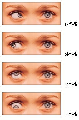 儿童斜视影响的不仅仅是外观