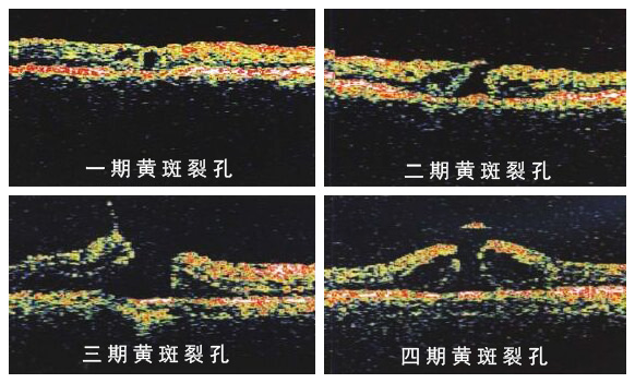 黄斑裂孔需尽早手术松解牵拉