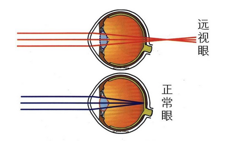 家长注意，孩子远视也会引起弱视