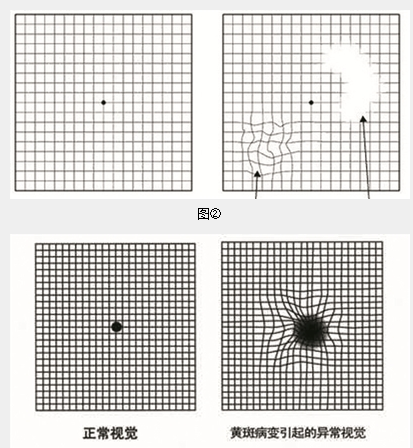 看东西变形需要查查眼底黄斑