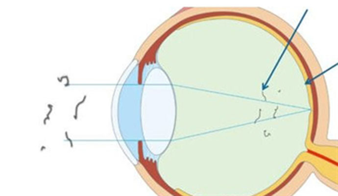 还在数着“蚊子”过日子吗?治疗飞蚊症的方法