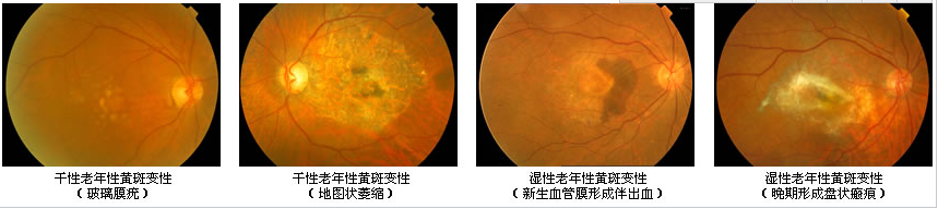 关注中老年“视力杀手”--黄斑病变